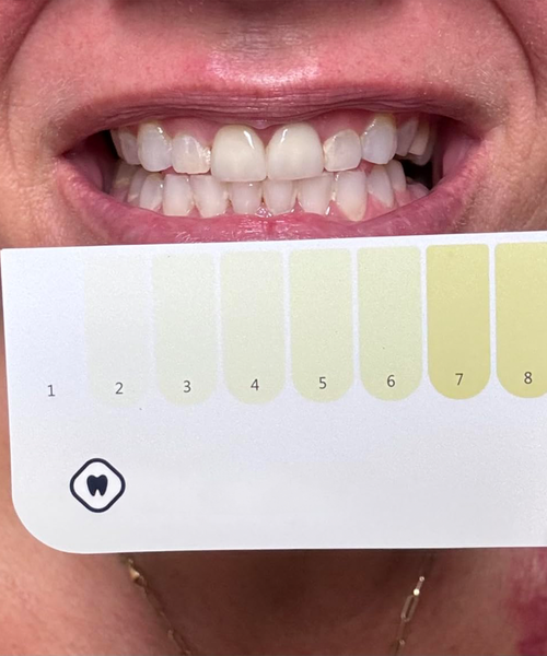 Dr. Dent Purple Teeth Whitening Strips for Stain Removal