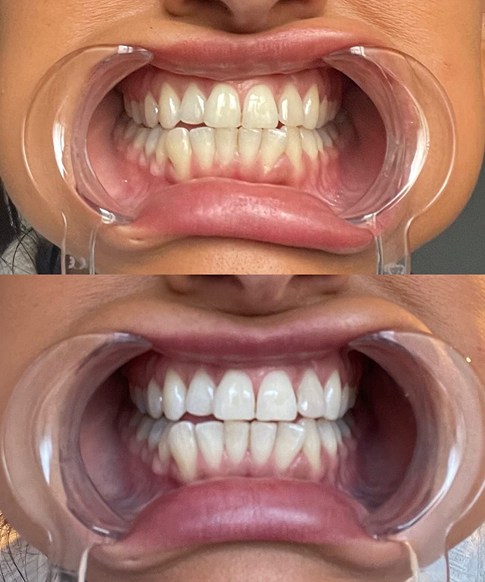 Dr. Dent Purple Teeth Whitening Strips for Stain Removal