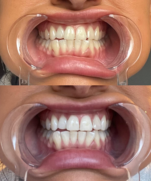 Dr. Dent Purple Teeth Whitening Strips for Stain Removal